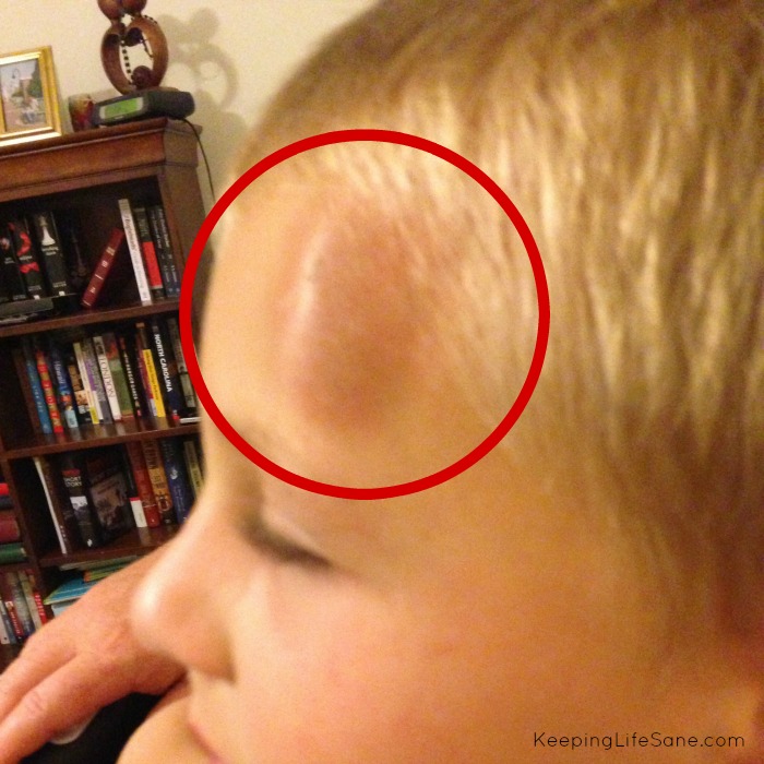 closeup of kids head with big goose egg on forehead from falling